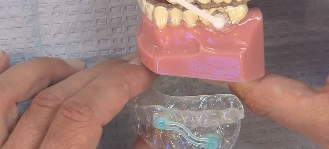 8 beneficios de la Terapia con Dispositivos Dentales para ronquido