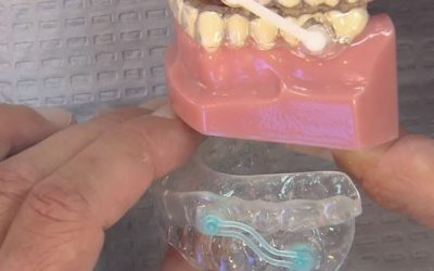 8 beneficios de la Terapia con Dispositivos Dentales para ronquido